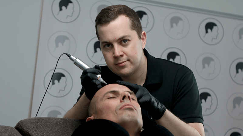 Haarpigmentierung in Aktion bei Alopecia androgentica