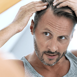 Erste Anzeichen von Haarausfall beginnen meist an der Haarlinie