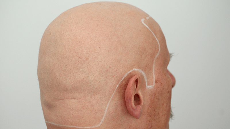 Mann mit Alopecia totalis bekommt seine neue Haarlinie angezeichnet