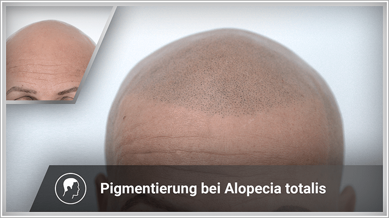 Volle Haarlinie trotz Alopecia totalis dank Haarpigmentierung
