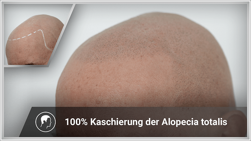 Mann mit Alopecia totalis hat wieder eine normale Haardichte