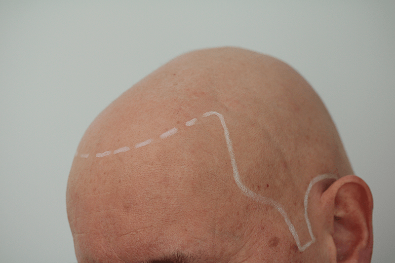 Mann mit Alopecia universalis bekommt seine neue Haarlinie