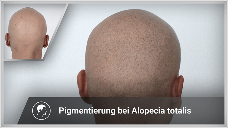 Mann bekommt nach vielen Jahren Alopecia universalis wieder einen frischen Look mit Haarpigmentierung