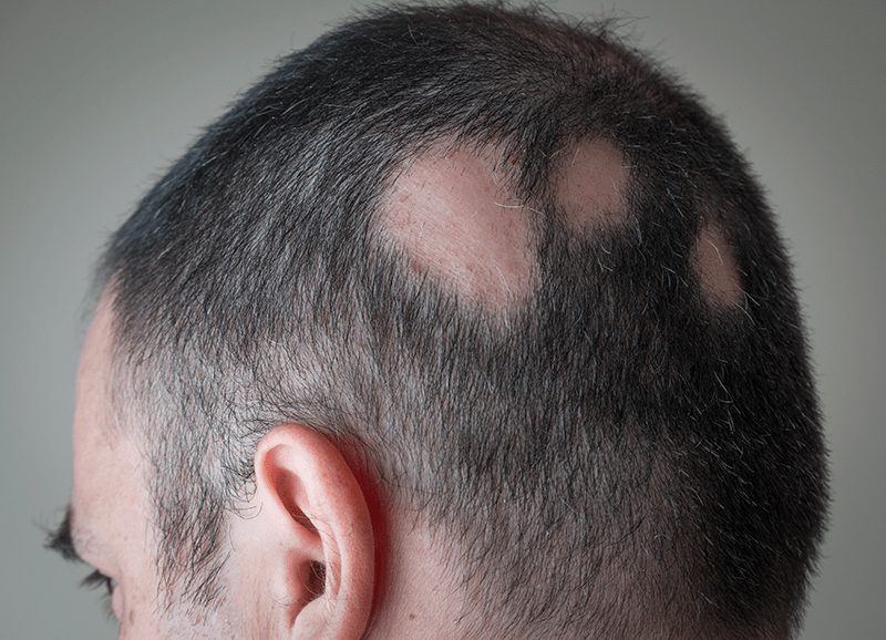 Mann mit Alopecia areata hat kahle Stellen am Hinterkopf