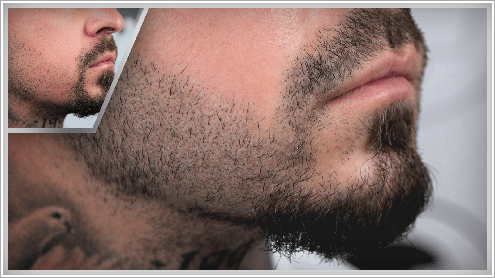 Bart nachher minoxidil vorher Vollbart durch