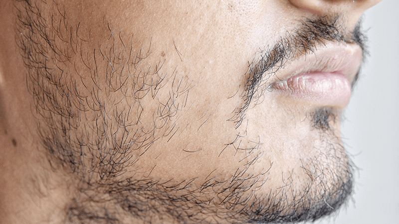 Mann mit lücken im Bart