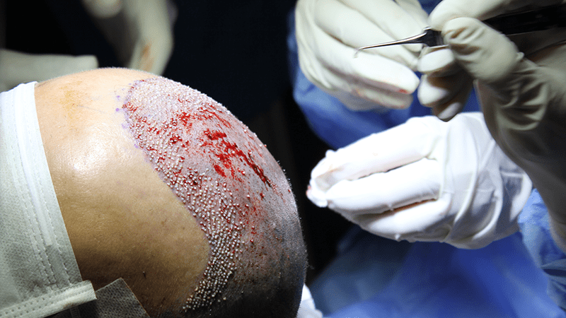 FUE-Haartransplantation im Prozess