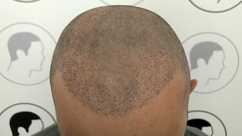FUE Haartransplantation in schlechter Ausführung