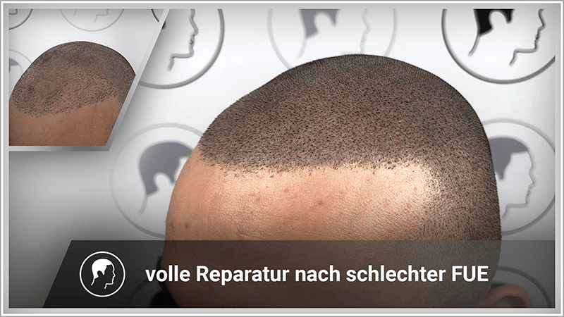 Haarpigmentierung kaschiert FUE Haartransplantation