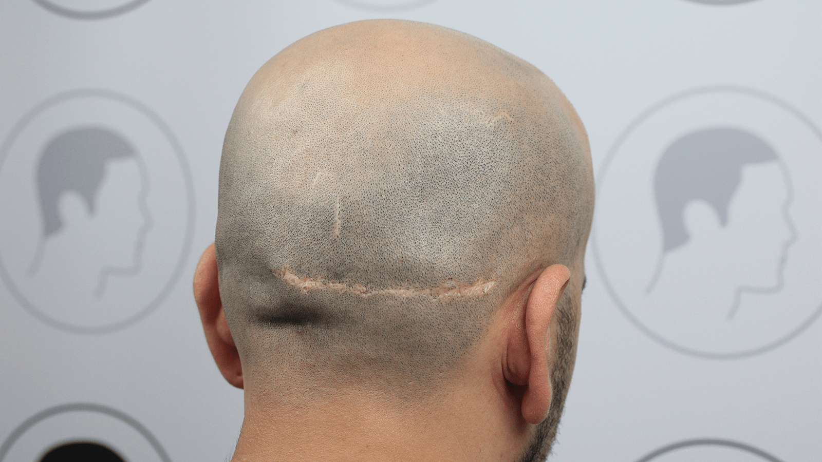 Fut Haartransplantation Risiken Und Vorteile