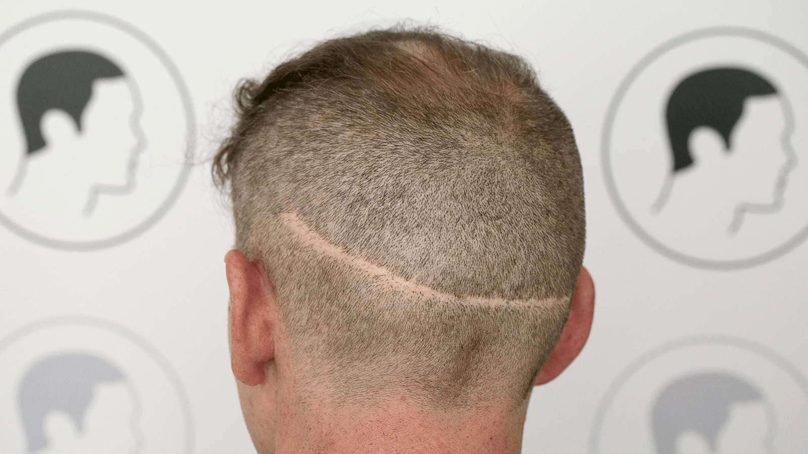 Fut Haartransplantation Risiken Und Vorteile