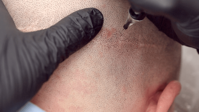 Prozess der FUT Narbenpigmentierung