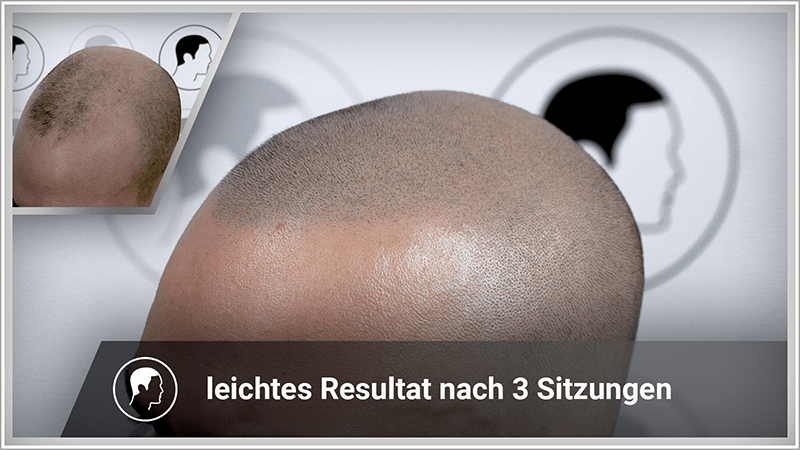 Ein natürliches Resultat der Haarpigmentierung.
