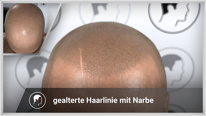 Haarpigmentierung mit gealterter Haarlinie und Narbe.