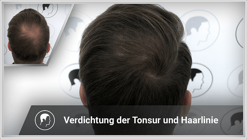Haarpigmentierung als Verdichtung einer lichten Tonsur