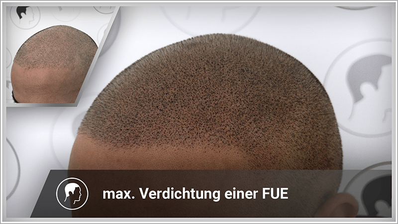 Haarverdichtung nach FUT Haartransplantation