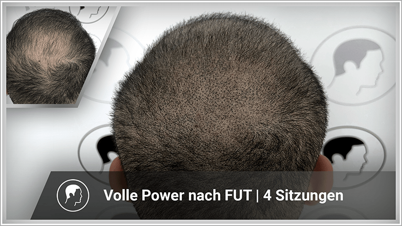 Haarpigmentierung verbessert FUT Haartransplantation auf der Tonsur
