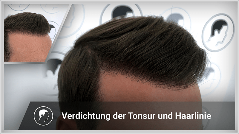 Haarverdichtung einer Haarlinie mit Haarpigmentierung