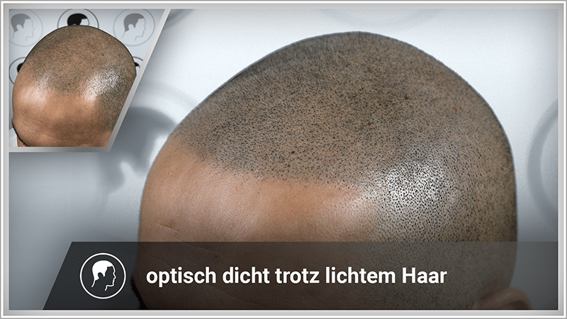 Haarpigmentierung ist eine nachhaltige Lösung bei Haarausfall