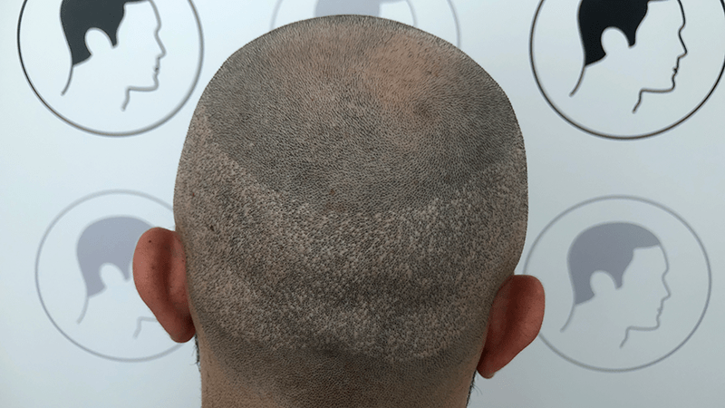 Lichter Spenderbereich nach Haartransplantation