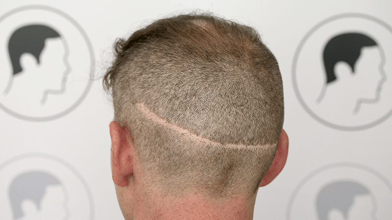 Lange Streifennarbe am Hinterkopf nach FUT Haartransplantation
