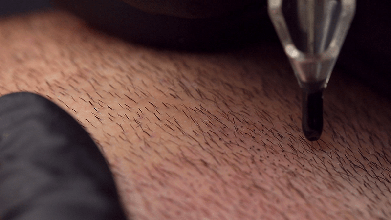 Pigmentierung der FUE-Narben im Donorbereich