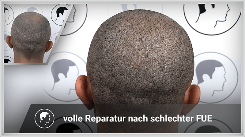 Volle Kaschierung von FUE-Narben im Spenderberich