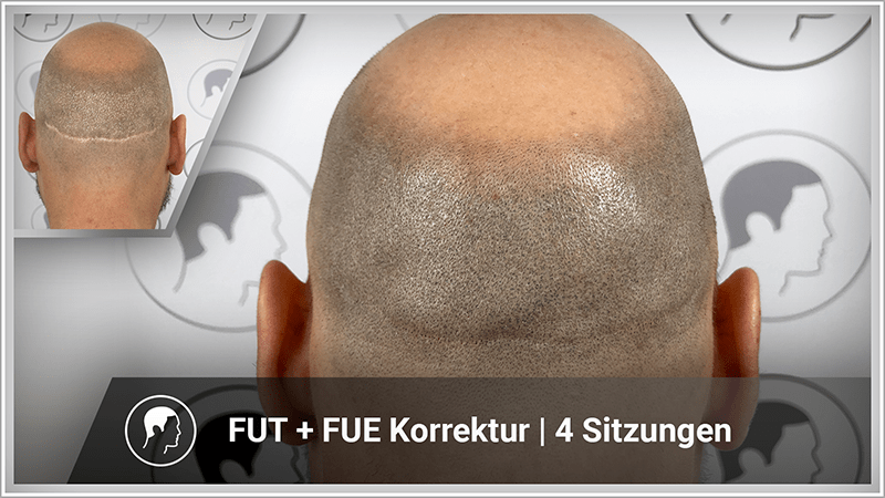 Kaschierung von FUT und FUE Narben