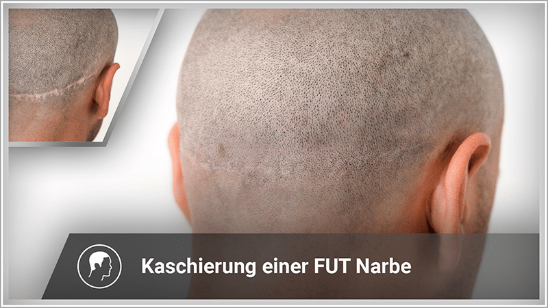 Keine sichtbare FUT-Narbe dank Haarpigmentierung