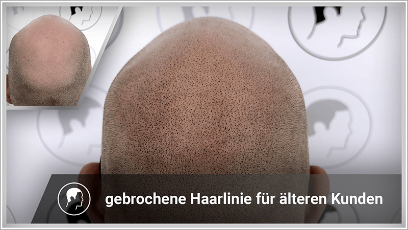 Wie beim Toupet, wird auch mit Haarpigmentierung der komplette Haarausfall kaschiert