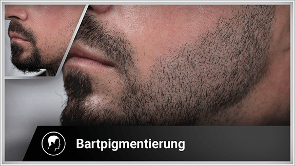 Bartpigmentierung linke Seite