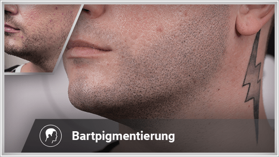Bartpigmentierung linke Seite