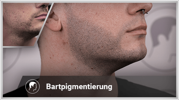 Bartpigmentierung rechte Seite