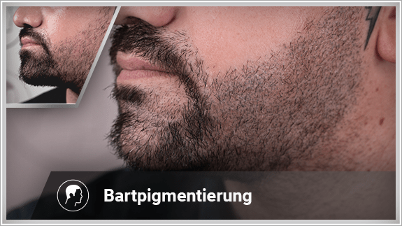 Bartpigmentierung linke Seite