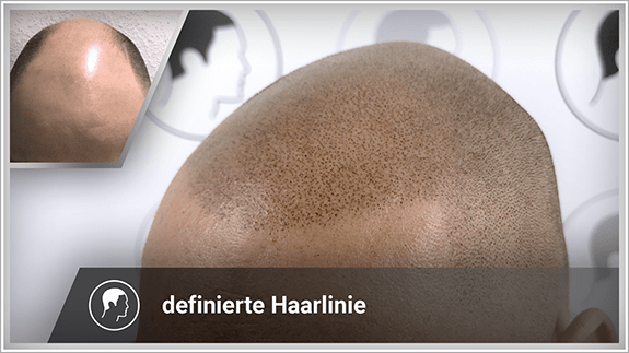 definierte Haarlinie