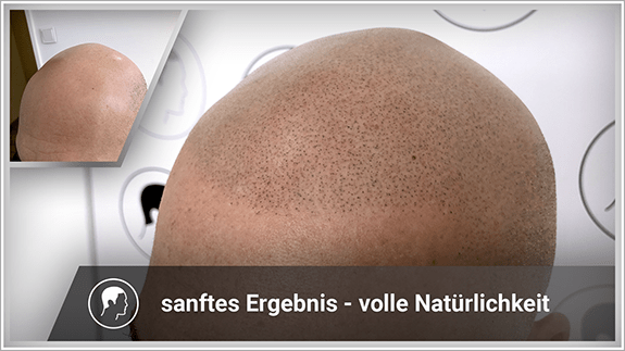 sanftes Ergebniss - volle Natürlichkeit