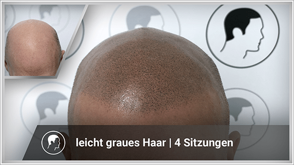 leicht graues Haar - 4 Sitzungen