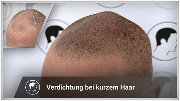 Verdichtung bei kurzem Haar