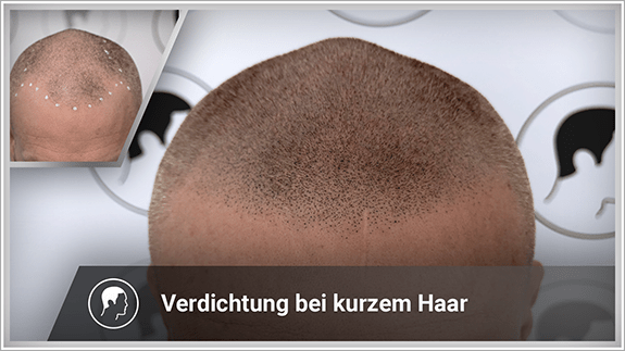 Verdichtung bei kurzem Haar