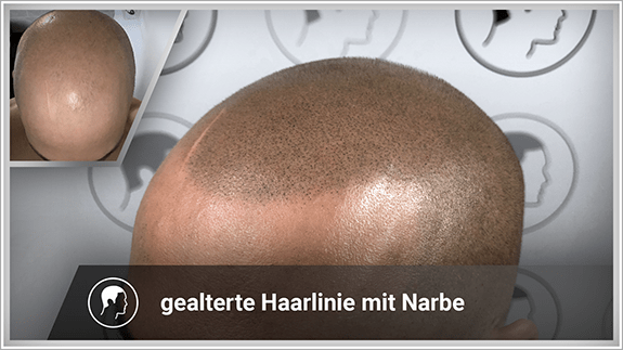 gealterte Haarlinie mit Narbe