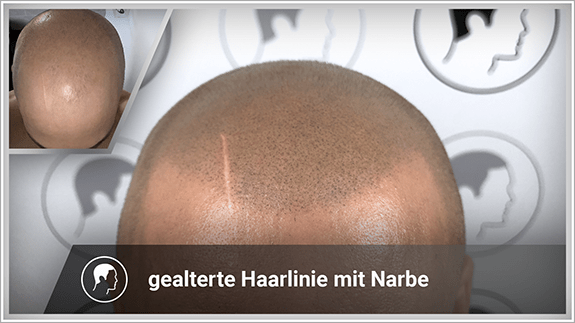 gealterte Haarlinie mit Narbe