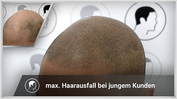 maximaler Haarausfall bei jungem Kunden