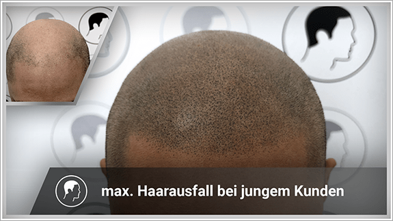 maximaler Haarausfall bei jungem Kunden