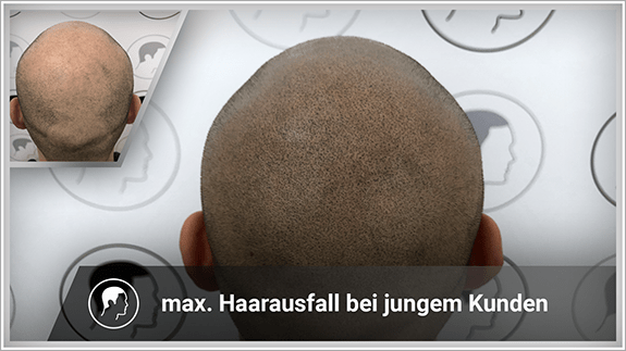 maximaler Haarausfall bei jungem Kunden