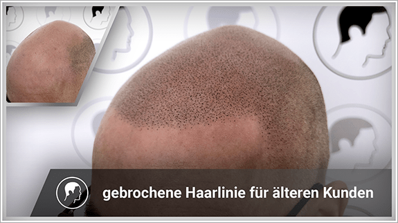 gebrochene Haarlinie für älteren Kunden