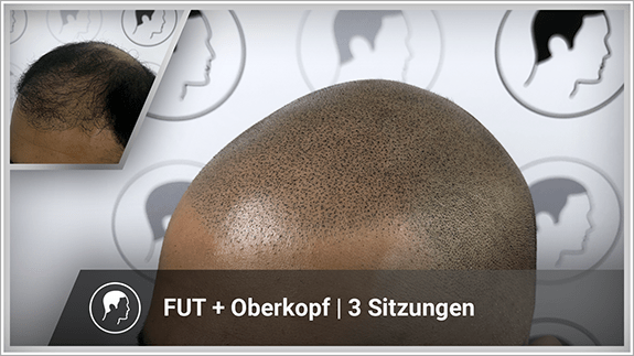 FUT + Oberkopf - 3 Sitzungen