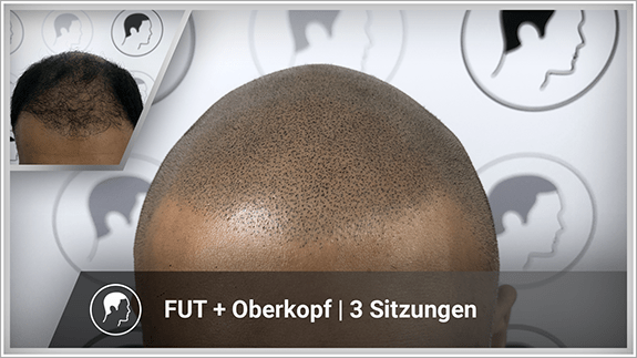 FUT + Oberkopf - 3 Sitzungen