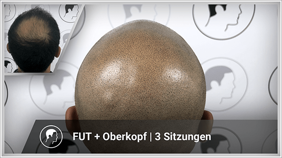 FUT + Oberkopf - 3 Sitzungen