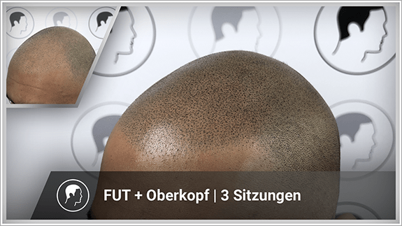 FUT + Oberkopf - 3 Sitzungen