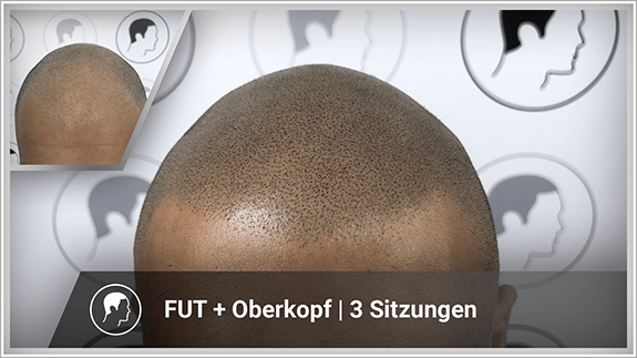 FUT + Oberkopf - 3 Sitzungen